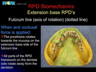 2.rpd biomechanics | PPT