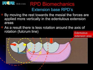2.rpd biomechanics | PPT