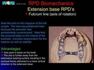 Mesial Rest Rpd 2.rpd biomechanics | PPT