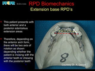 Posterior Rpd 2.rpd biomechanics | PPT