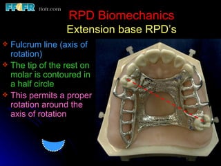 2.rpd biomechanics | PPT