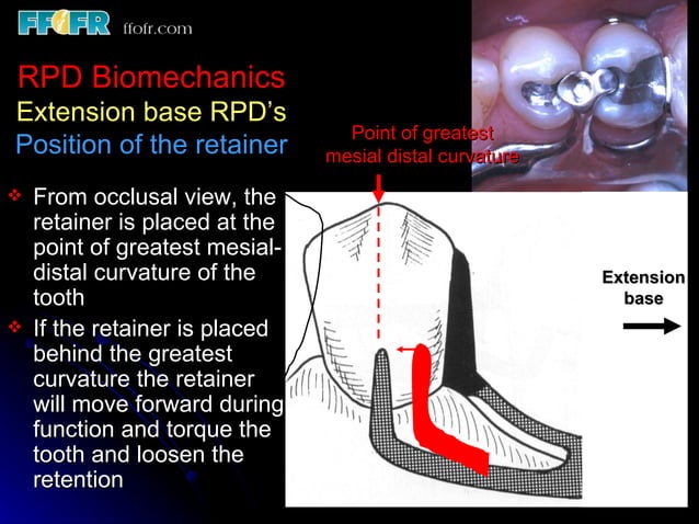 2.rpd biomechanics | PPT | Dental Health | Diseases and Conditions