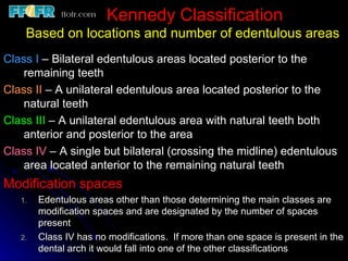 Edentulous Class Rpd 2.rpd biomechanics | PPT