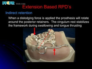Posterior Rpd 2.rpd biomechanics | PPT