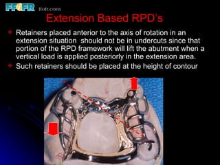 Retainer In Rpd 2.rpd biomechanics | PPT