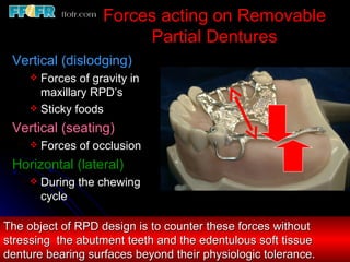 Maxillary Lateral Rpd 2.rpd biomechanics | PPT
