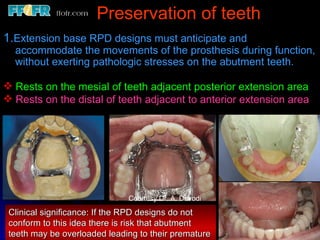 Mesial Rest Rpd 2.rpd biomechanics | PPT