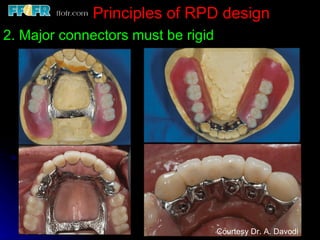 2.rpd biomechanics | PPT