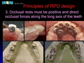 Skeletal Rests Design Rpd 2.rpd biomechanics | PPT