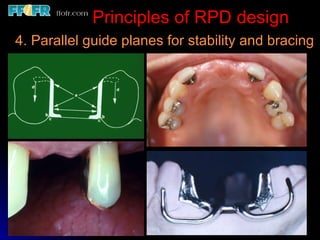 2.rpd biomechanics | PPT