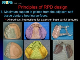 Casted Rpd 2.rpd biomechanics | PPT
