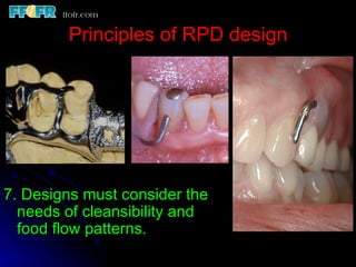 Precision Rpd Design 2.rpd biomechanics | PPT