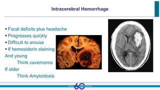 Intracerebral Hemorrhage
 Focal deficits plus headache
 Progresses quickly
 Difficult to arouse
 If hemosiderin staining
And young
Think cavernoma
If older
Think Amyloidosis
 