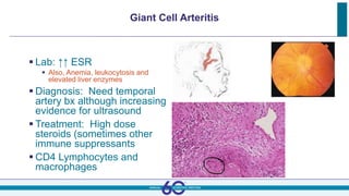 Giant Cell Arteritis
 Lab: ↑↑ ESR
 Also, Anemia, leukocytosis and
elevated liver enzymes
 Diagnosis: Need temporal
artery bx although increasing
evidence for ultrasound
 Treatment: High dose
steroids (sometimes other
immune suppressants
 CD4 Lymphocytes and
macrophages
 