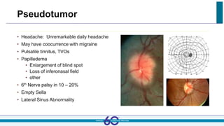 Pseudotumor
• Headache: Unremarkable daily headache
• May have coocurrence with migraine
• Pulsatile tinnitus, TVOs
• Papilledema
• Enlargement of blind spot
• Loss of inferonasal field
• other
• 6th Nerve palsy in 10 – 20%
• Empty Sella
• Lateral Sinus Abnormality
 