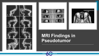 MRI Findings in
Pseudotumor
 