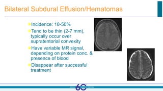 Bilateral Subdural Effusion/Hematomas
Incidence: 10-50%
Tend to be thin (2-7 mm),
typically occur over
supratentorial convexity
Have variable MR signal,
depending on protein conc. &
presence of blood
Disappear after successful
treatment
 