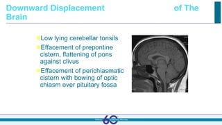 Downward Displacement of The
Brain
Low lying cerebellar tonsils
Effacement of prepontine
cistern, flattening of pons
against clivus
Effacement of perichiasmatic
cistern with bowing of optic
chiasm over pituitary fossa
 