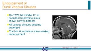 Engorgement of
Dural Venous Sinuses
On T1W the middle 1/3 of
dominant transverse sinus,
shows convex borders
All venous sinuses become
engorged
The falx & tentorium show marked
enhancement
AJNR 2007 ; 28:1489-93
 