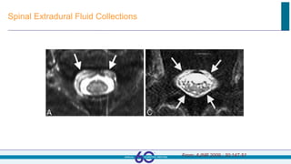 Spinal Extradural Fluid Collections
From: AJNR 2009.; 30:147-51
 