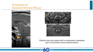 Prominent of
Epidural Venous Plexus
AJNR 2009.; 30:147-51
Patients may even present with a compressive myelopathy
due to a prominent venous epidural plexus.
 