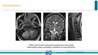 Complications
Patient with known intracranial hypotension who rapidly
deteriorated shows cerebellar, brainstem & cord infarctions.
AJNR 2009, doi:10.3174/ajnr.A1749
 