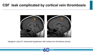CSF leak complicated by cortical vein thrombosis
Iatrogenic- post LP- intracranial hypotension with cortical vein thrombosis (arrow).
 