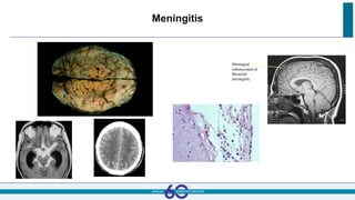 Meningitis
 