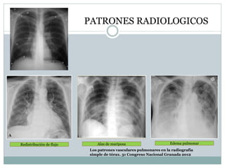PATRONES RADIOLOGICOS
Redistribución de flujo Alas de mariposa Edema pulmonar
Los patrones vasculares pulmonares en la radiografía
simple de tórax. 31 Congreso Nacional Granada 2012
 