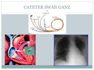 CATETER SWAN GANZ
 