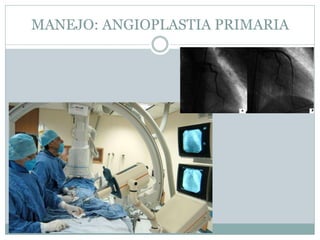 MANEJO: ANGIOPLASTIA PRIMARIA
 