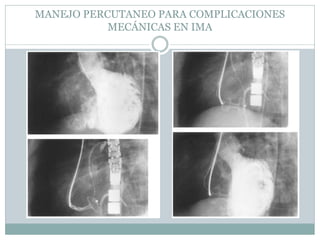 MANEJO PERCUTANEO PARA COMPLICACIONES
MECÁNICAS EN IMA
 