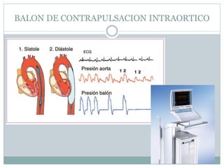 BALON DE CONTRAPULSACION INTRAORTICO
 