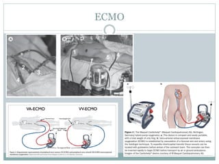 ECMO
 