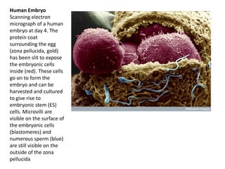Human Embryo
Scanning electron
micrograph of a human
embryo at day 4. The
protein coat
surrounding the egg
(zona pellucida, gold)
has been slit to expose
the embryonic cells
inside (red). These cells
go on to form the
embryo and can be
harvested and cultured
to give rise to
embryonic stem (ES)
cells. Microvilli are
visible on the surface of
the embryonic cells
(blastomeres) and
numerous sperm (blue)
are still visible on the
outside of the zona
pellucida
 