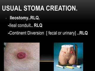 Stoma Inversion Tool 2-Stoma Creation human being (ne2w).pptx