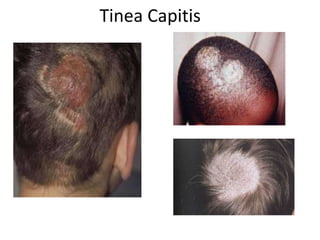 Tinea Capitis
 
