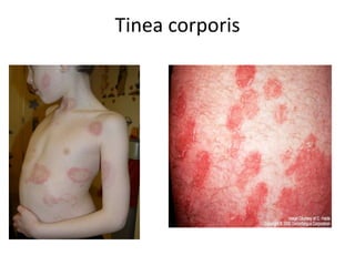 Tinea corporis
 