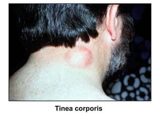 Tinea corporis
 