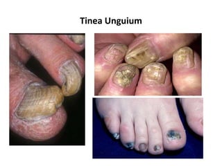 Tinea Unguium
 
