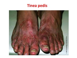 Tinea pedis
 