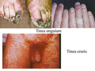 Tinea unguium
Tinea cruris
 