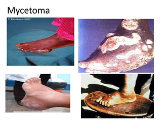 Mycetoma
 