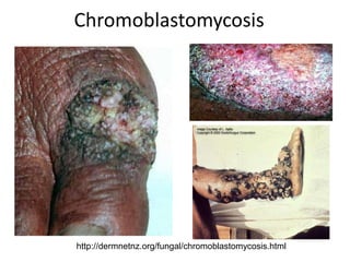 Chromoblastomycosis
http://dermnetnz.org/fungal/chromoblastomycosis.html
 