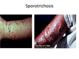 Sporotrichosis
 