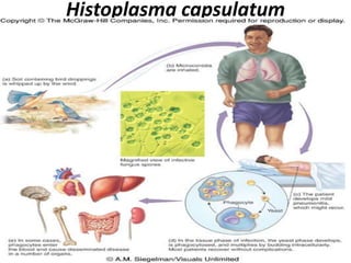 Histoplasma capsulatum
 
