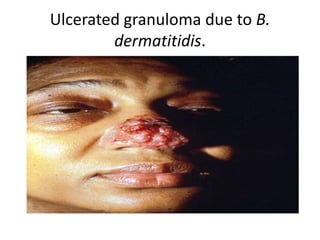 Ulcerated granuloma due to B.
dermatitidis.
 