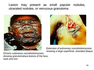35
Chronic cutaneous coccidioidomycosis
showing granulomatous lesions of the face,
neck and chin
Extension of pulmonary coccidioidomycosis
showing a large superficial, ulcerated plaque
Lesion may present as small papular nodules,
ulcerated nodules, or verrucous granuloma
 