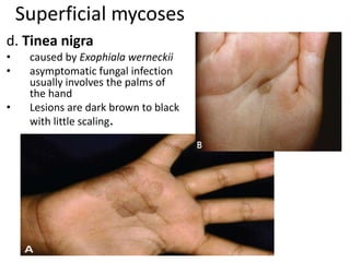 Superficial mycoses
d. Tinea nigra
• caused by Exophiala werneckii
• asymptomatic fungal infection
usually involves the palms of
the hand
• Lesions are dark brown to black
with little scaling.
 