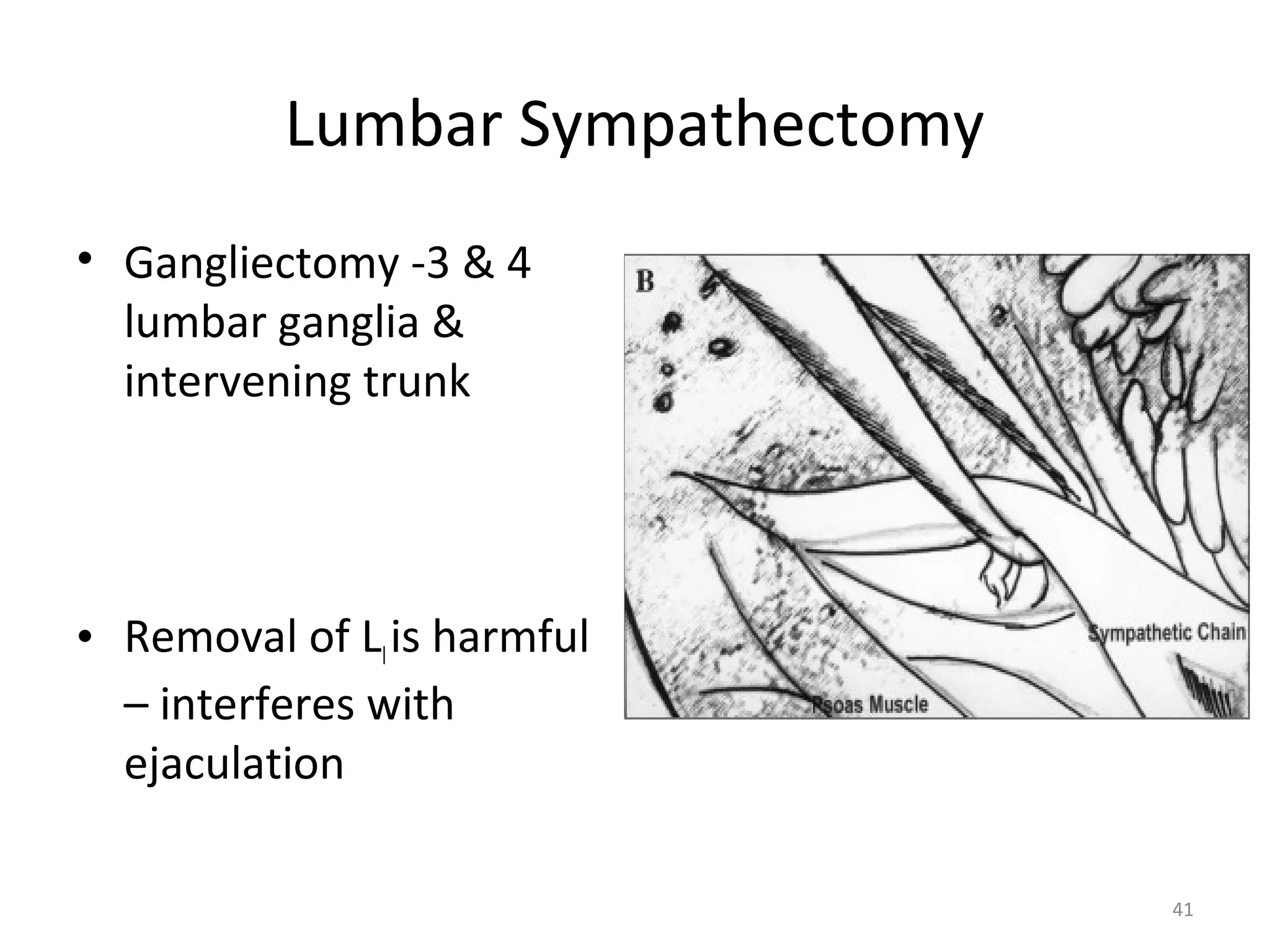 41
Lumbar Sympathectomy
• Gangliectomy -3 & 4
lumbar ganglia &
intervening trunk
• Removal of LIis harmful
– interferes with
ejaculation
 